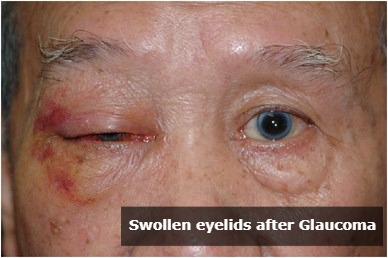 swollen eyelids after glaucoma surgery
